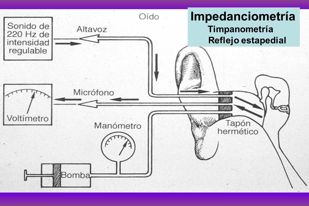 HIPOACUSIAS DE TRANSMISIÓN ppt descargar Impedanciometría: timpanometría y reflejo estapedial
